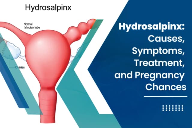 Hydrosalpinx
